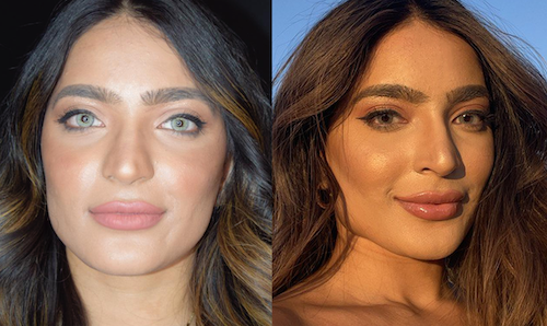 Cheek Enhancement Dermal Fillers Before After Mississauga Oakville